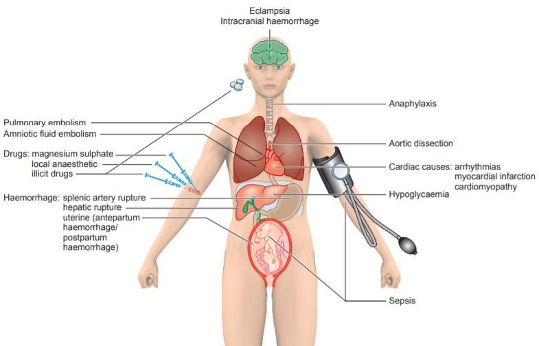 Figure from Immediate Resuscitation Following Maternal Collapse During Pregnancy