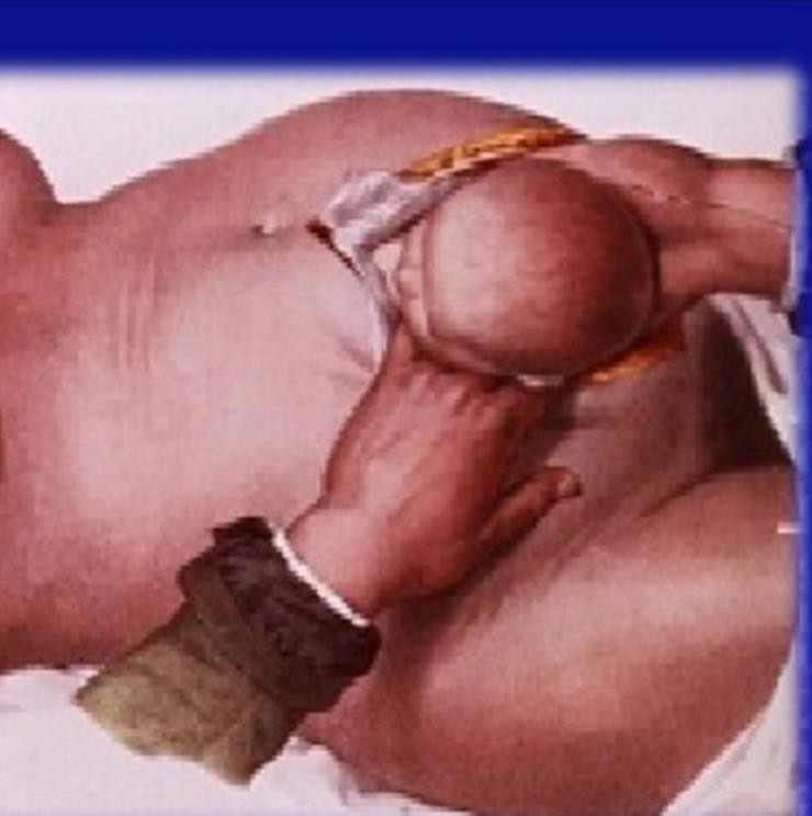 Figure from Immediate Resuscitation Following Maternal Collapse During Pregnancy