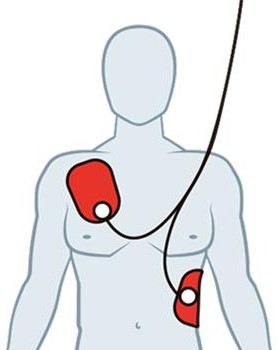 Figure from Immediate Resuscitation Following Maternal Collapse During Pregnancy