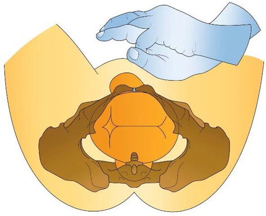 Figure from Shoulder Dystocia