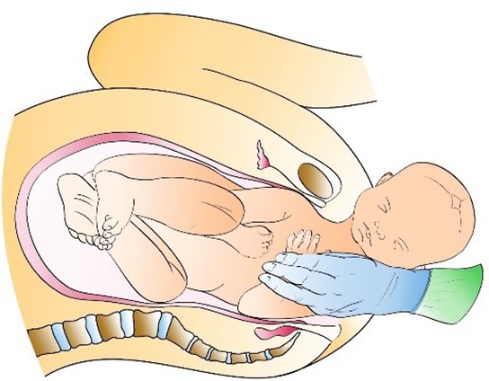 Figure from Shoulder Dystocia