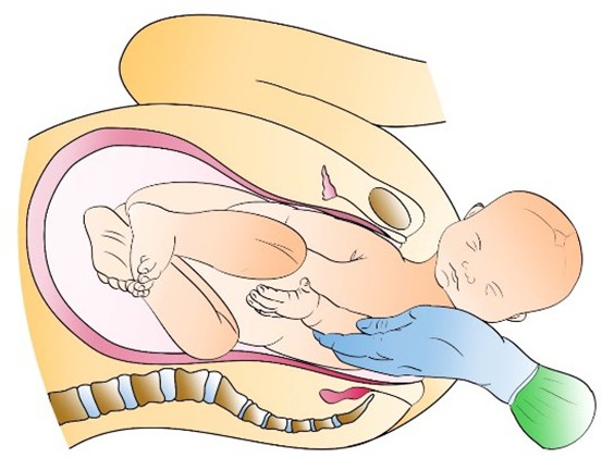 Figure from Shoulder Dystocia