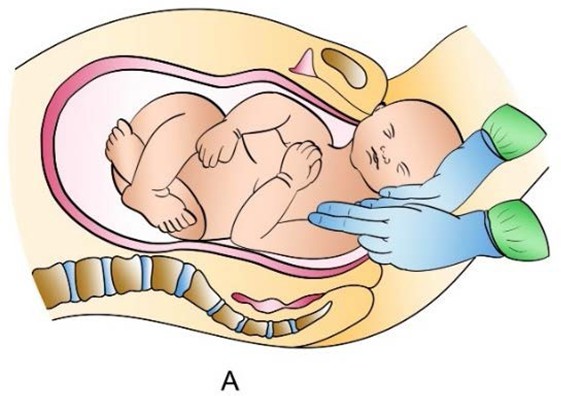 Figure from Shoulder Dystocia