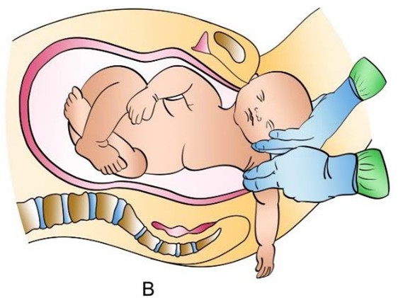 Figure from Shoulder Dystocia