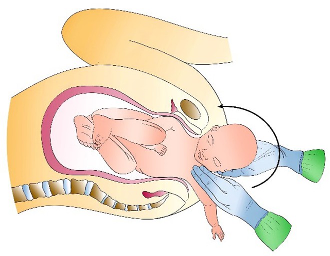 Figure from Shoulder Dystocia