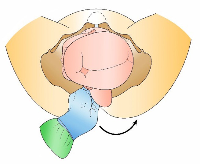 Figure from Shoulder Dystocia