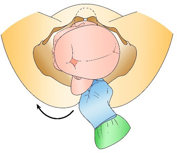 Figure from Shoulder Dystocia