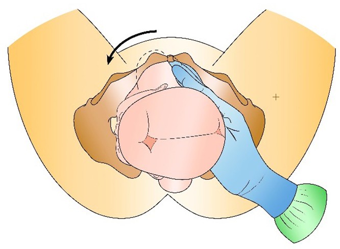 Figure from Shoulder Dystocia