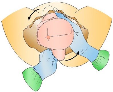 Figure from Shoulder Dystocia