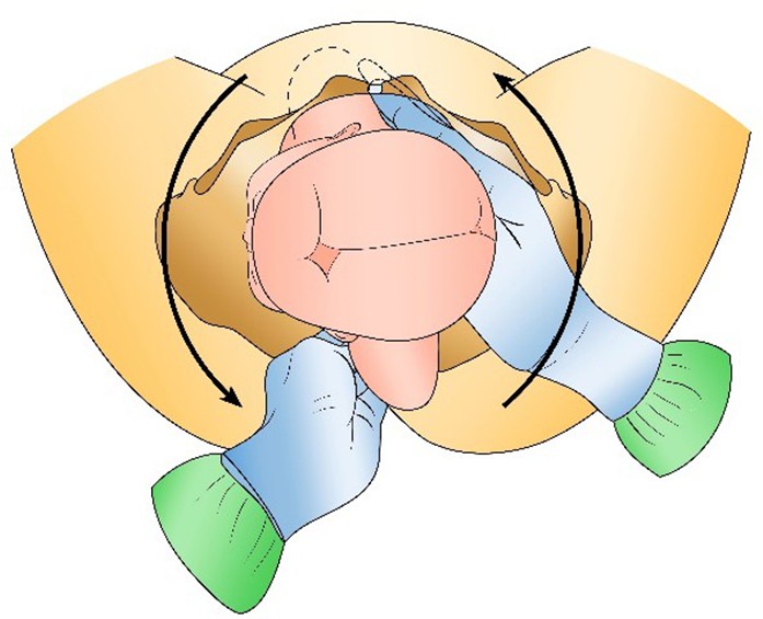 Figure from Shoulder Dystocia