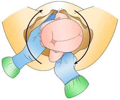Figure from Shoulder Dystocia